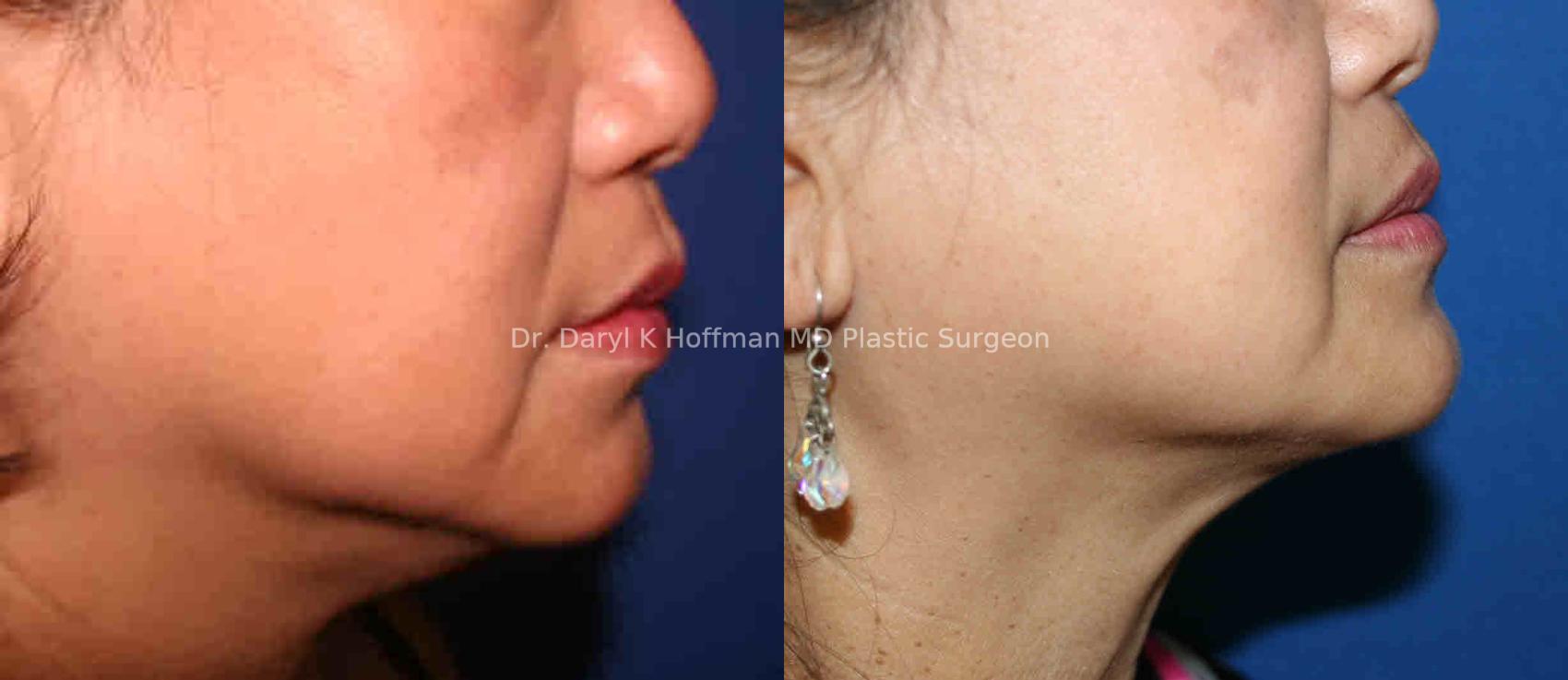 Liposuction Case 44 Before & After View #2 | San Jose & Palo Alto, CA | Daryl K. Hoffman, MD