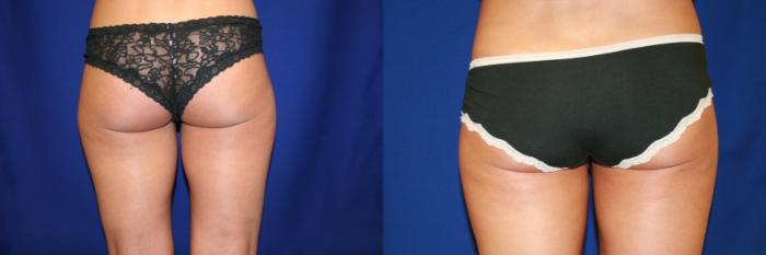 Liposuction Case 55 Before & After View #2 | San Jose & Palo Alto, CA | Daryl K. Hoffman, MD