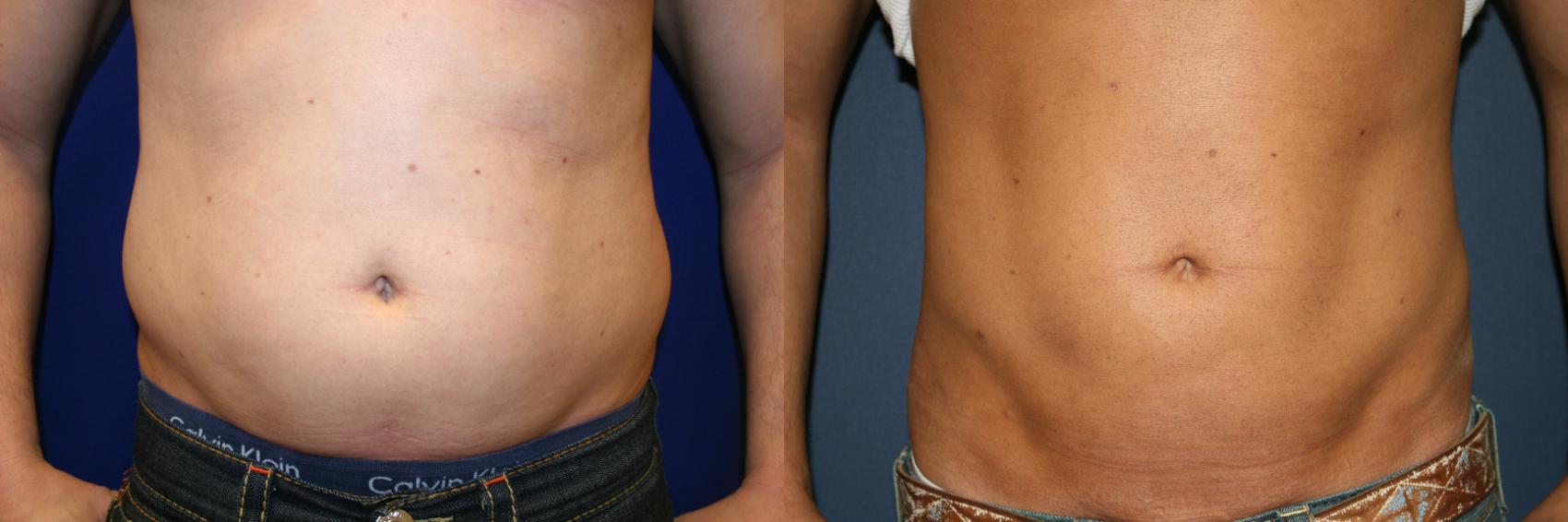 Liposuction Case 57 Before & After View #1 | San Jose & Palo Alto, CA | Daryl K. Hoffman, MD