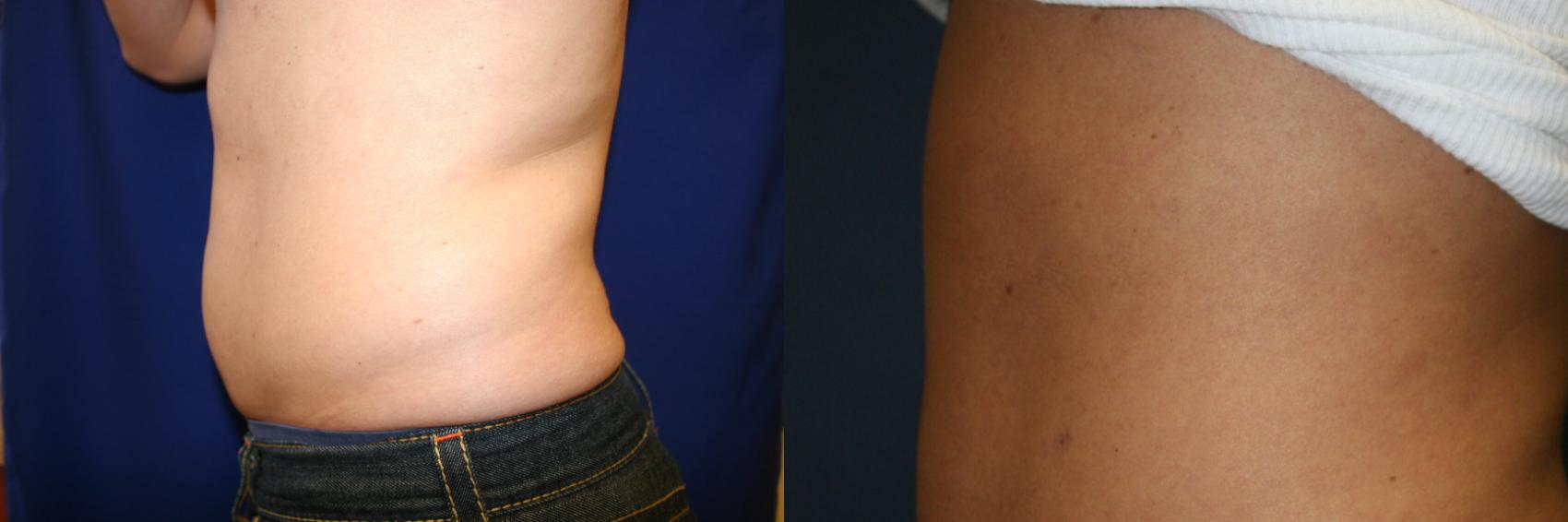 Liposuction Case 57 Before & After View #2 | San Jose & Palo Alto, CA | Daryl K. Hoffman, MD