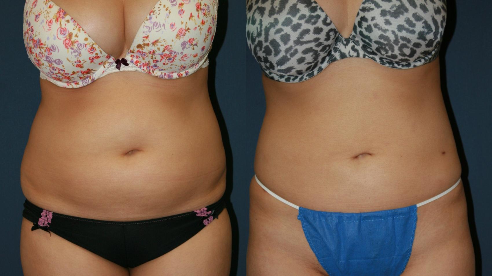 Liposuction Case 58 Before & After View #1 | San Jose & Palo Alto, CA | Daryl K. Hoffman, MD