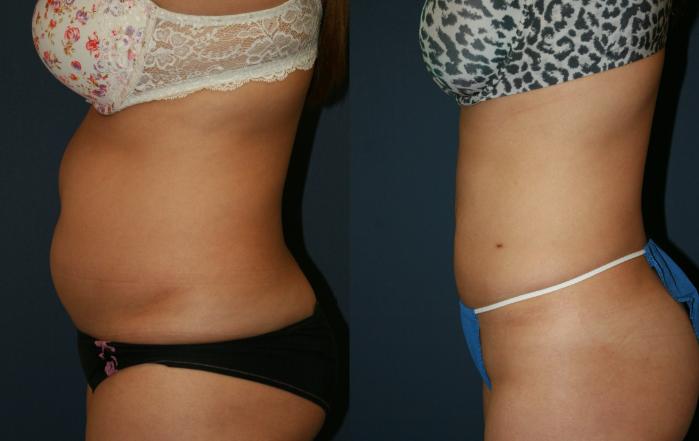 Liposuction Case 58 Before & After View #2 | San Jose & Palo Alto, CA | Daryl K. Hoffman, MD