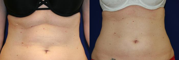 Liposuction Case 59 Before & After View #1 | San Jose & Palo Alto, CA | Daryl K. Hoffman, MD