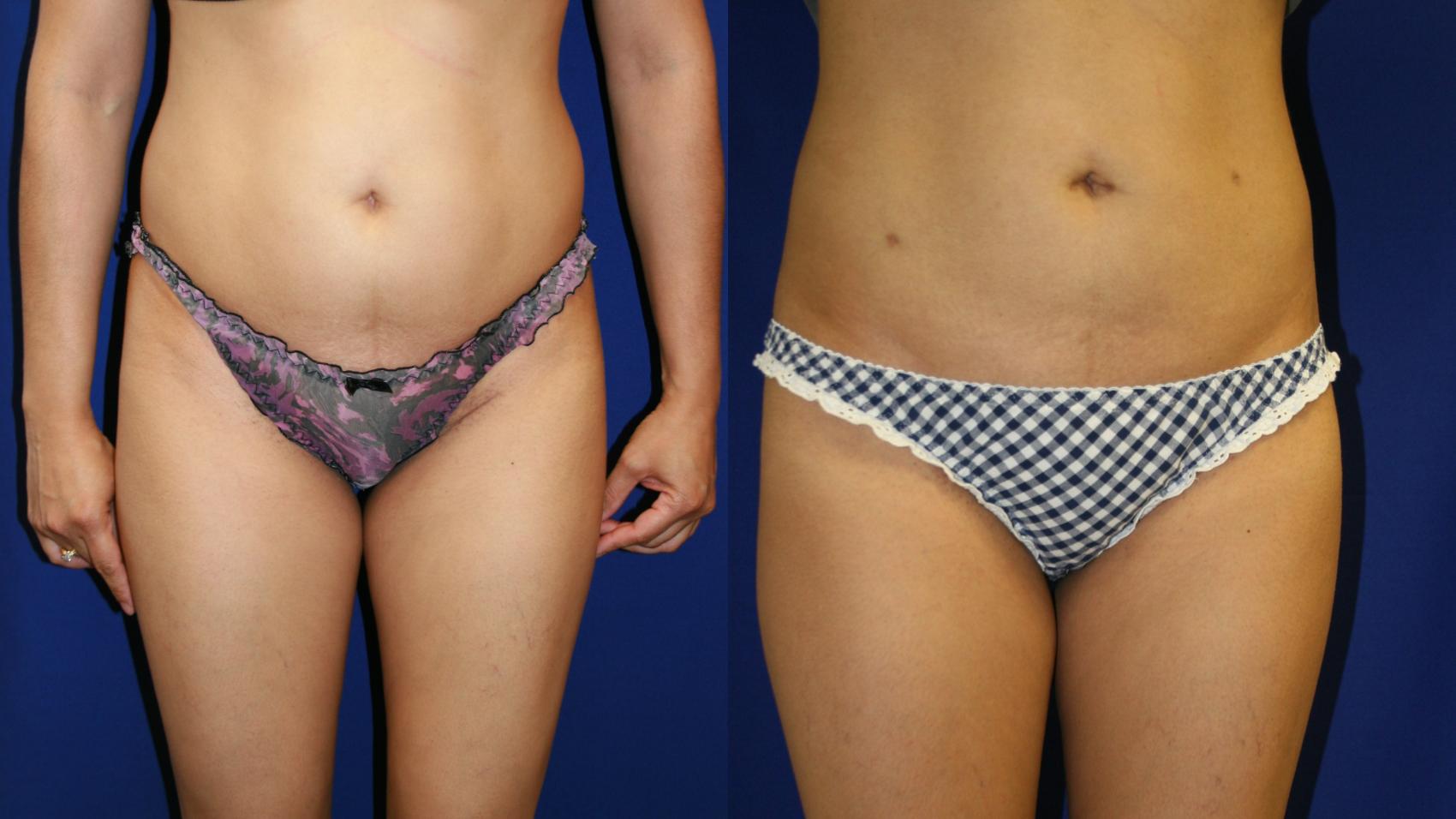 Liposuction Case 60 Before & After View #1 | San Jose & Palo Alto, CA | Daryl K. Hoffman, MD