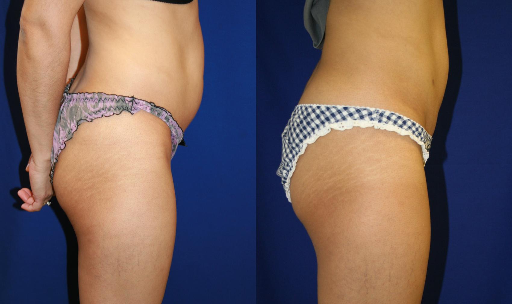 Liposuction Case 60 Before & After View #2 | San Jose & Palo Alto, CA | Daryl K. Hoffman, MD