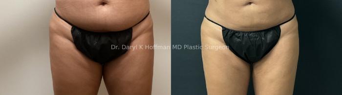 Liposuction Case 67 Before & After Front | San Jose & Palo Alto, CA | Daryl K. Hoffman, MD