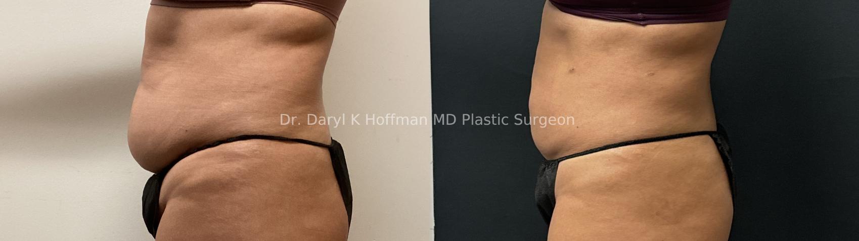 Liposuction Case 67 Before & After Left Side | San Jose & Palo Alto, CA | Daryl K. Hoffman, MD