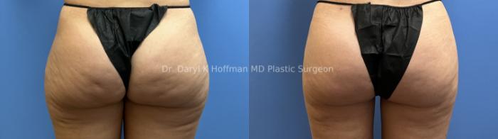 Liposuction Case 72 Before & After Back | San Jose & Palo Alto, CA | Daryl K. Hoffman, MD