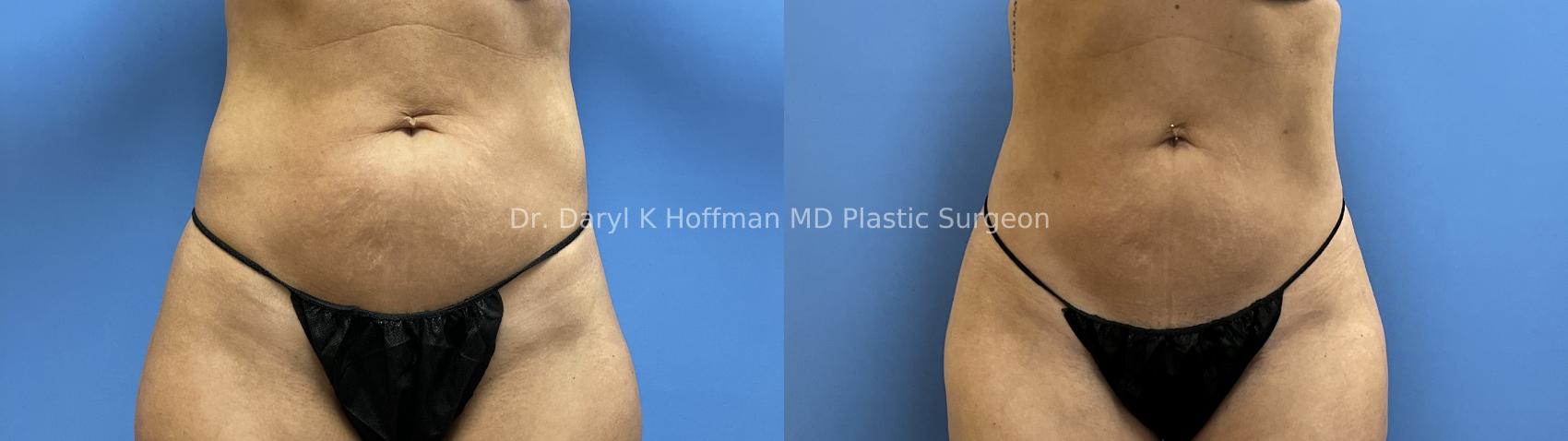 Liposuction Case 72 Before & After Front | San Jose & Palo Alto, CA | Daryl K. Hoffman, MD