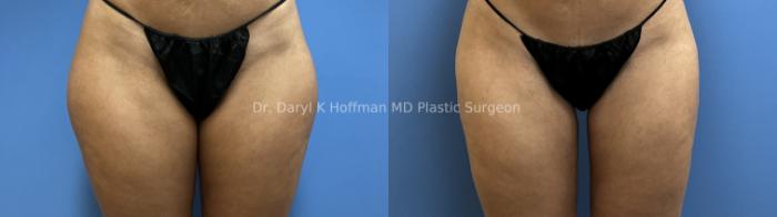 Liposuction Case 72 Before & After Thigh  | San Jose & Palo Alto, CA | Daryl K. Hoffman, MD