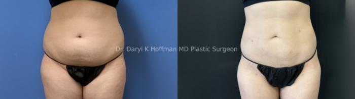 Liposuction Case 88 Before & After Front | San Jose & Palo Alto, CA | Daryl K. Hoffman, MD