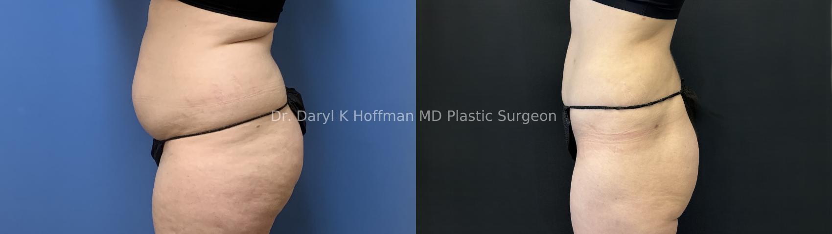 Liposuction Case 88 Before & After Left Side | San Jose & Palo Alto, CA | Daryl K. Hoffman, MD