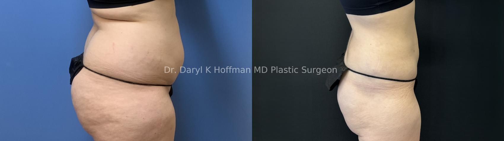 Liposuction Case 88 Before & After Right Side | San Jose & Palo Alto, CA | Daryl K. Hoffman, MD