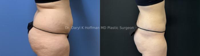 Liposuction Case 88 Before & After Right Side | San Jose & Palo Alto, CA | Daryl K. Hoffman, MD