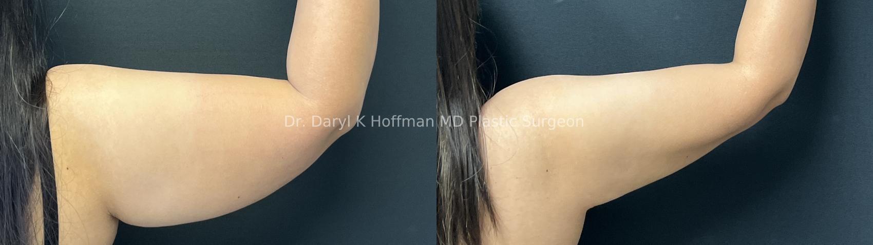Liposuction Case 90 Before & After Back | San Jose & Palo Alto, CA | Daryl K. Hoffman, MD