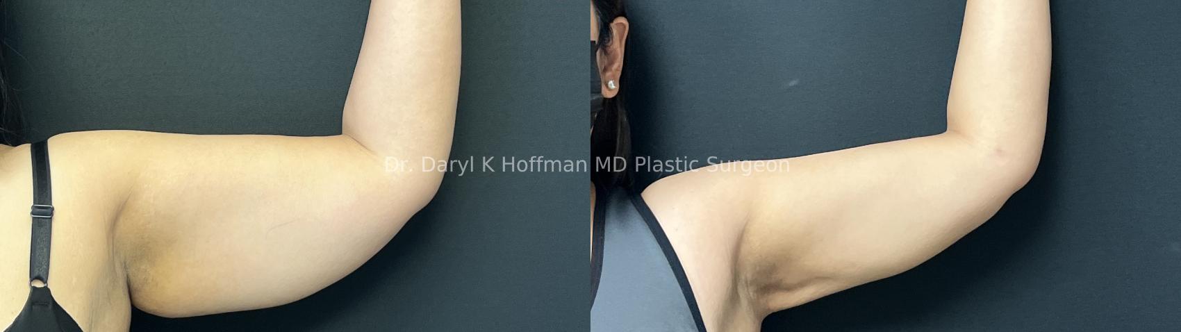 Liposuction Case 90 Before & After Front | San Jose & Palo Alto, CA | Daryl K. Hoffman, MD