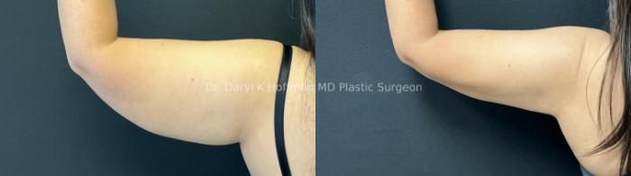 Liposuction Case 90 Before & After Left Side | San Jose & Palo Alto, CA | Daryl K. Hoffman, MD