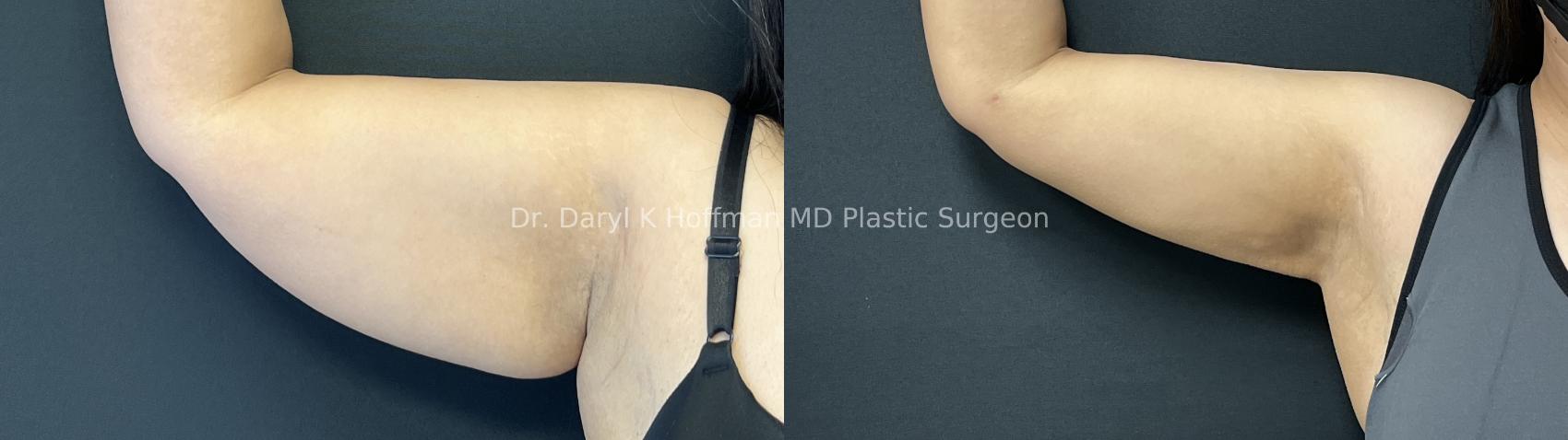 Liposuction Case 90 Before & After Right front view  | San Jose & Palo Alto, CA | Daryl K. Hoffman, MD