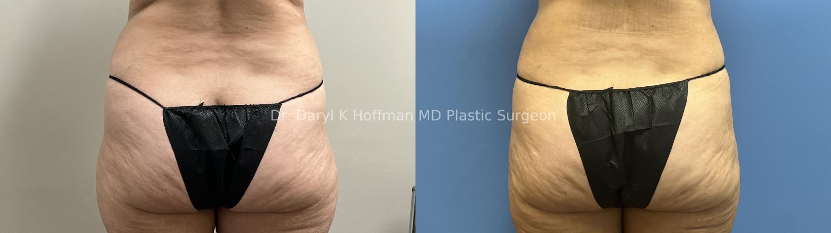 Liposuction Case 95 Before & After Back | San Jose & Palo Alto, CA | Daryl K. Hoffman, MD