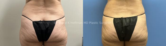 Liposuction Case 95 Before & After Back | San Jose & Palo Alto, CA | Daryl K. Hoffman, MD
