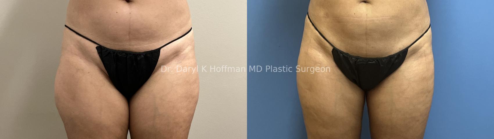 Liposuction Case 95 Before & After Front | San Jose & Palo Alto, CA | Daryl K. Hoffman, MD