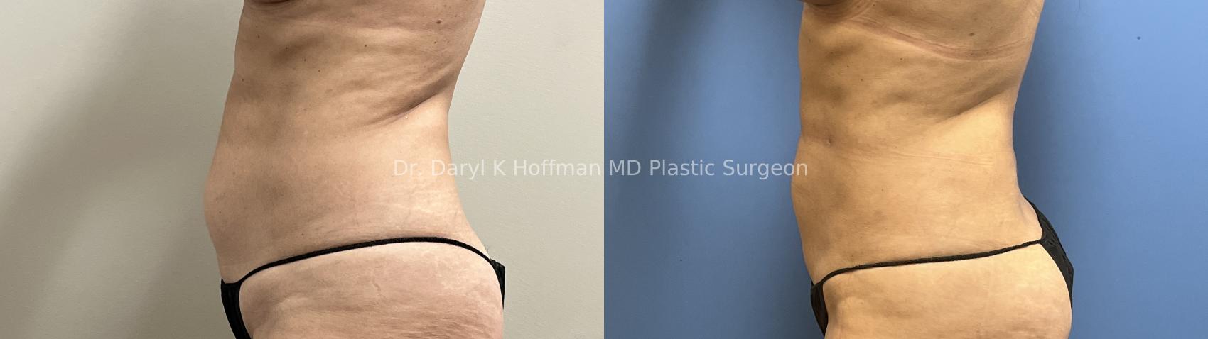 Liposuction Case 95 Before & After Left Side | San Jose & Palo Alto, CA | Daryl K. Hoffman, MD