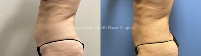 Liposuction Case 95 Before & After Left Side | San Jose & Palo Alto, CA | Daryl K. Hoffman, MD