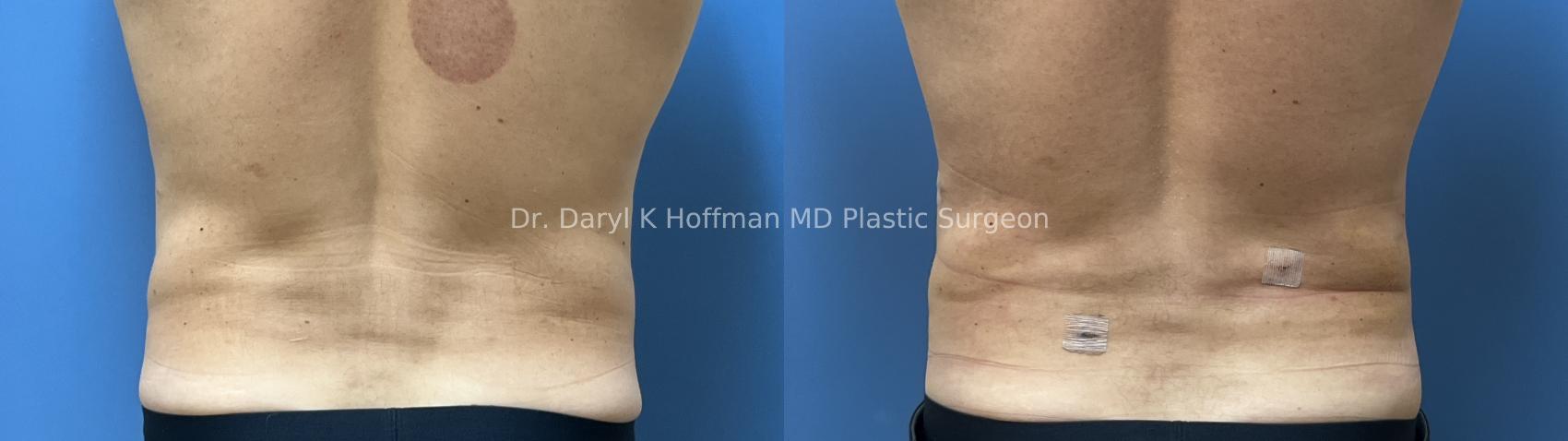 Liposuction Case 96 Before & After Back | San Jose & Palo Alto, CA | Daryl K. Hoffman, MD