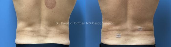 Liposuction Case 96 Before & After Back | San Jose & Palo Alto, CA | Daryl K. Hoffman, MD