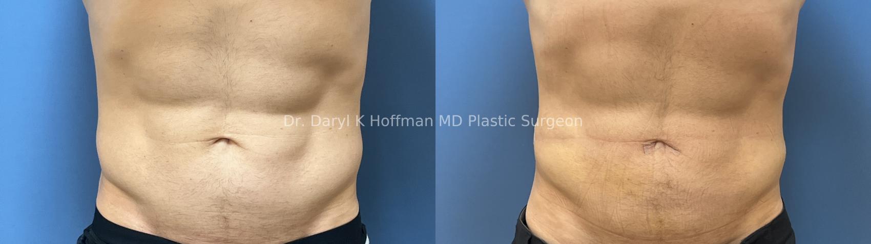 Liposuction Case 96 Before & After Front | San Jose & Palo Alto, CA | Daryl K. Hoffman, MD