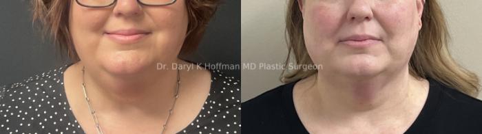 Submental liposuction  Case 66 Before & After Front | San Jose & Palo Alto, CA | Daryl K. Hoffman, MD