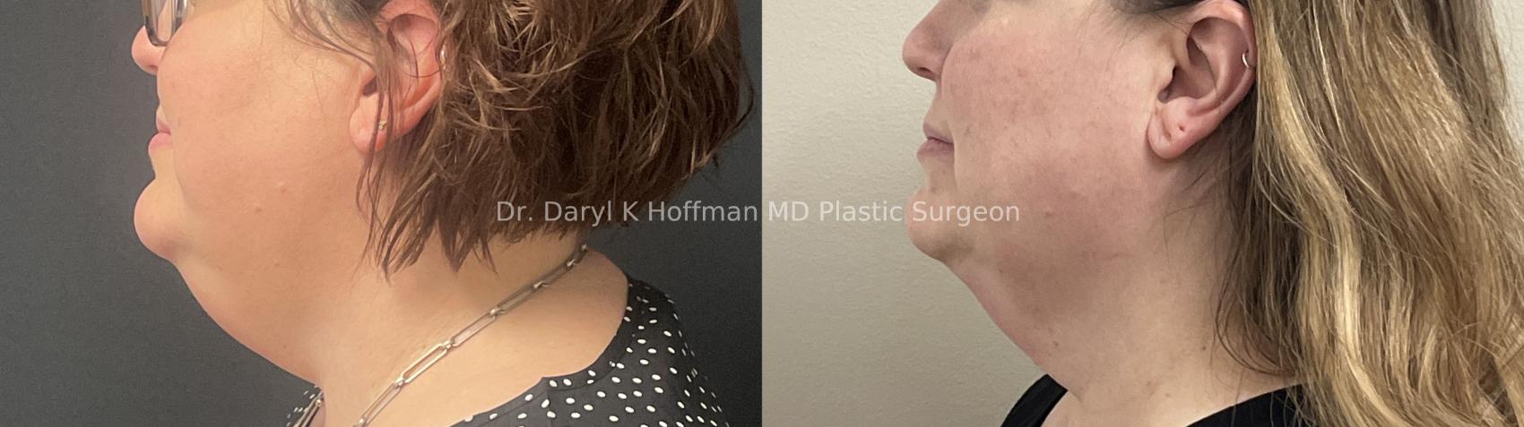 Submental liposuction  Case 66 Before & After Left Side | San Jose & Palo Alto, CA | Daryl K. Hoffman, MD