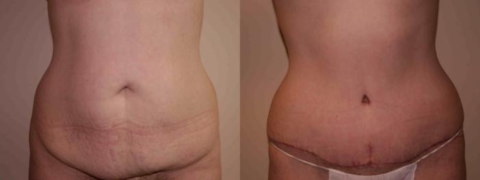 Tummy Tuck Case 35 Before & After View #1 | San Jose & Palo Alto, CA | Daryl K. Hoffman, MD