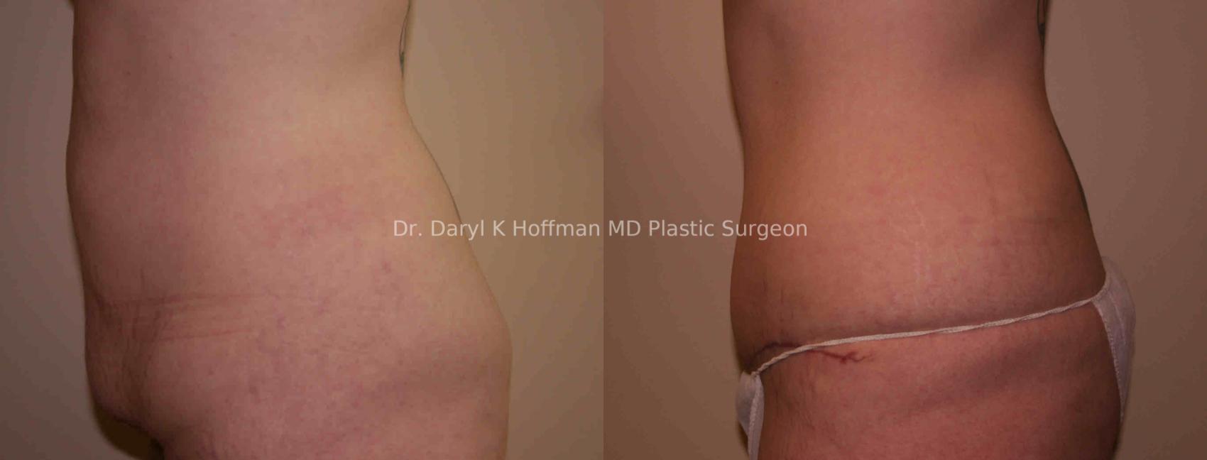 Tummy Tuck Case 35 Before & After View #2 | San Jose & Palo Alto, CA | Daryl K. Hoffman, MD
