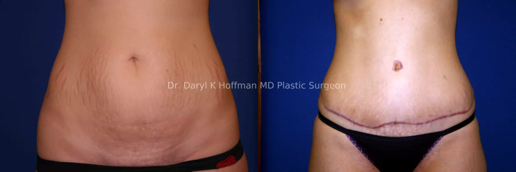 Tummy Tuck, San Jose CA