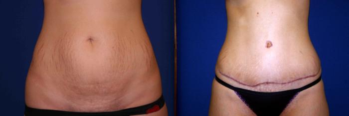 Tummy Tuck Case 36 Before & After View #1 | San Jose & Palo Alto, CA | Daryl K. Hoffman, MD