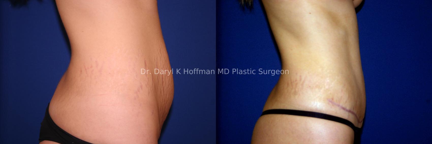 Tummy Tuck Case 36 Before & After View #2 | San Jose & Palo Alto, CA | Daryl K. Hoffman, MD