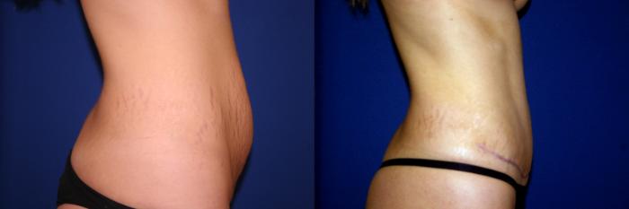 Tummy Tuck Case 36 Before & After View #2 | San Jose & Palo Alto, CA | Daryl K. Hoffman, MD