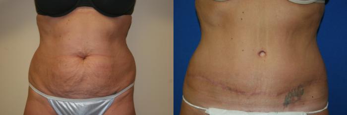 Tummy Tuck Case 38 Before & After View #1 | San Jose & Palo Alto, CA | Daryl K. Hoffman, MD