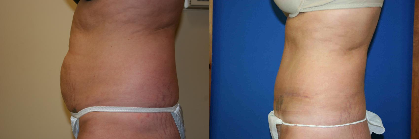 Tummy Tuck Case 38 Before & After View #2 | San Jose & Palo Alto, CA | Daryl K. Hoffman, MD