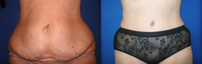 Tummy Tuck Case 39 Before & After View #1 | San Jose & Palo Alto, CA | Daryl K. Hoffman, MD