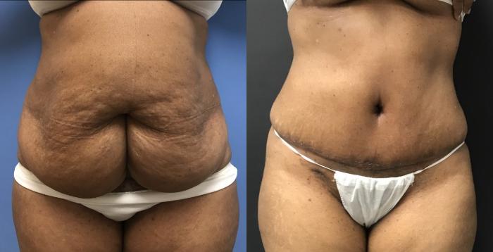 Tummy Tuck Case 63 Before & After View #1 | San Jose & Palo Alto, CA | Daryl K. Hoffman, MD