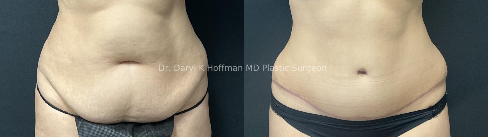 Tummy Tuck Case 69 Before & After Front | San Jose & Palo Alto, CA | Daryl K. Hoffman, MD