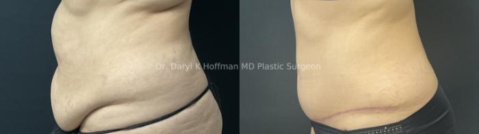 Tummy Tuck Case 69 Before & After Left Side | San Jose & Palo Alto, CA | Daryl K. Hoffman, MD