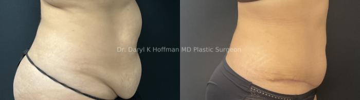 Tummy Tuck Case 69 Before & After Right Side | San Jose & Palo Alto, CA | Daryl K. Hoffman, MD