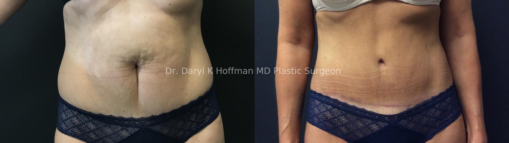 Tummy Tuck Case 74 Before & After Front | San Jose & Palo Alto, CA | Daryl K. Hoffman, MD