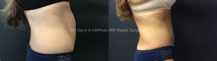 Tummy Tuck Case 74 Before & After Right Side | San Jose & Palo Alto, CA | Daryl K. Hoffman, MD