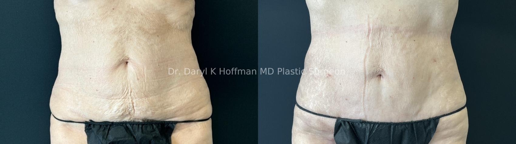 Tummy Tuck Case 81 Before & After Front | San Jose & Palo Alto, CA | Daryl K. Hoffman, MD