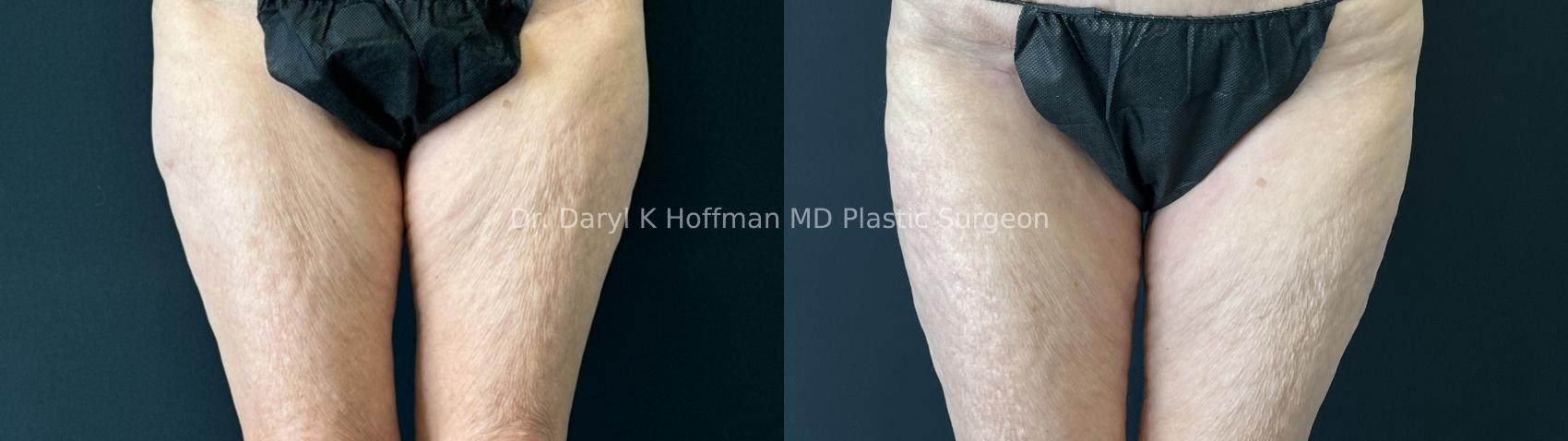 Tummy Tuck Case 81 Before & After Front Hips/thighs  | San Jose & Palo Alto, CA | Daryl K. Hoffman, MD
