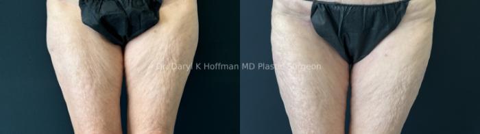 Tummy Tuck Case 81 Before & After Front Hips/thighs  | San Jose & Palo Alto, CA | Daryl K. Hoffman, MD